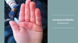 โรคมือเท้าปาก 02
